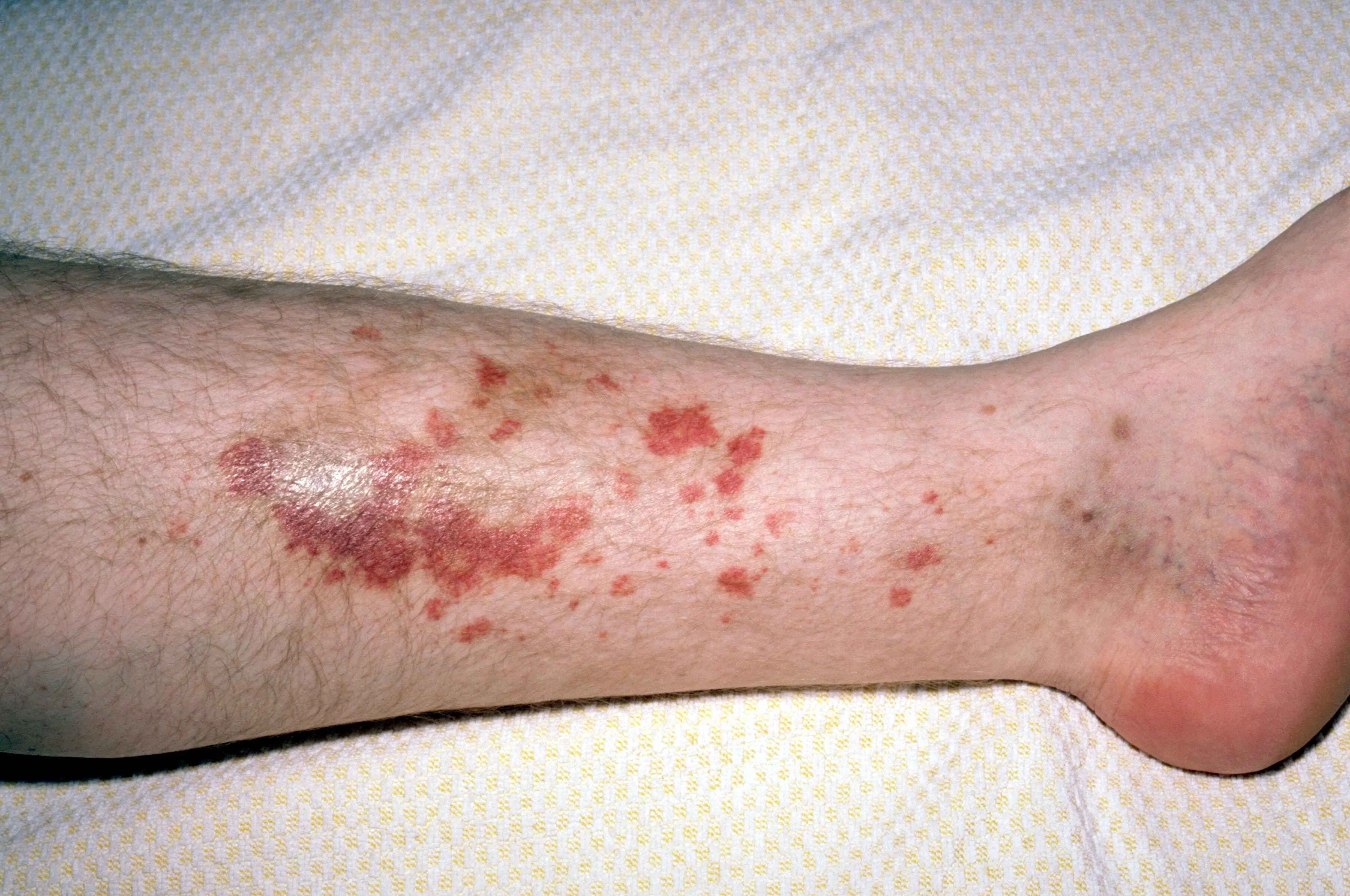 Blood cancer effects?