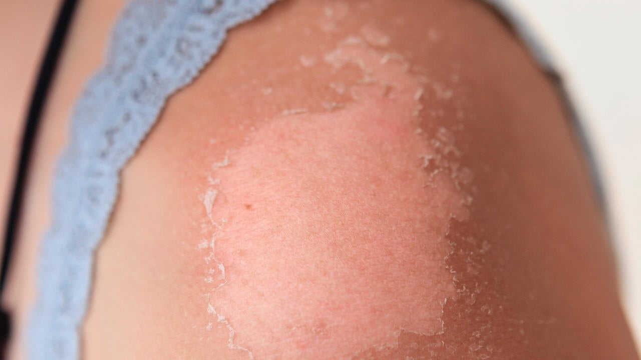 The Best Treatments for Sunburn, According to Dermatologists