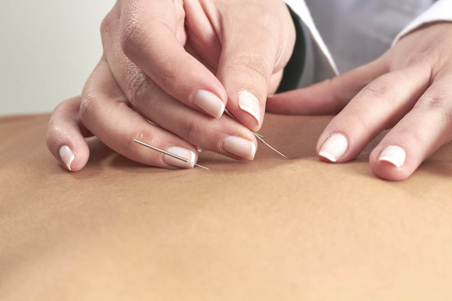 Can acupuncture assist to take away cussed back ache?
