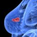 The 8 Breast Cancer Guidelines to Remember