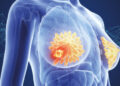 10 Breast Cancer Facts You Should Know About