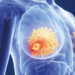 10 Breast Cancer Facts You Should Know About