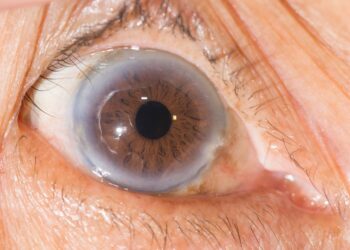 Cholesterol Eyes Causes