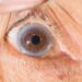 Cholesterol Eyes Causes