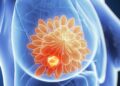 How To Find Breast Cancer Lumps – How Can I Avoid This In the Future?