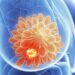 How To Find Breast Cancer Lumps – How Can I Avoid This In the Future?