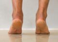 This DIY home cure for cracked heels works like an attraction!