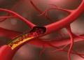 Cholesterol Good And Bad